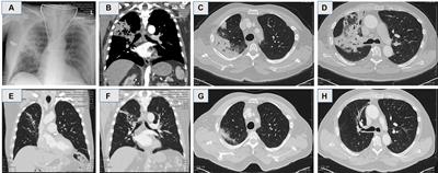 Adenomatous hyperplasia induced by chronic cherry pit retention mimicking an endobronchial tumor-case series and systematic review of literature